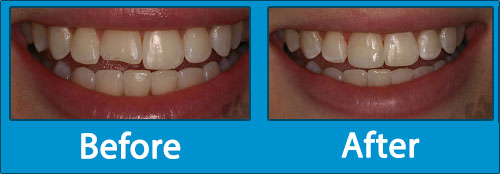 White Composite Fillings - Before-After